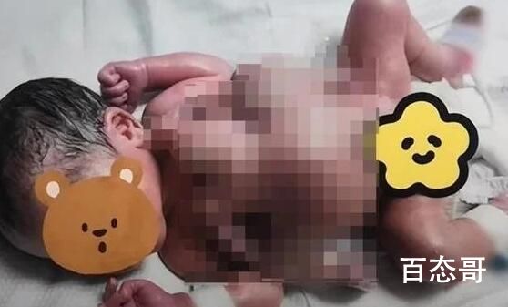 深圳一男婴出生时四手四脚 手术成功已经正常出院了
