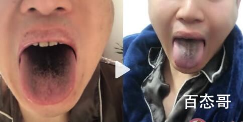 男子确诊后舌头牙齿全变黑 头发也能变黑就好了